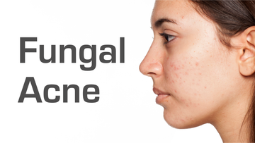 All About Fungal Acne